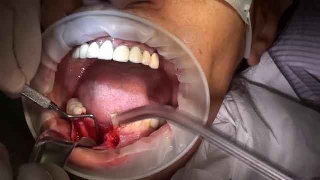 Костна аугментация с Bond Bone.