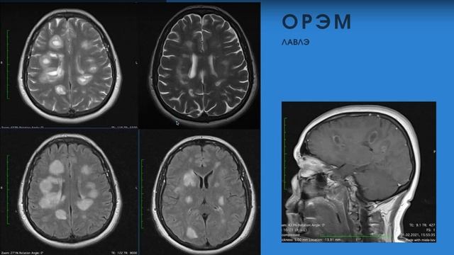 Демиелинирующие заболевания ЦНС -  рассеянный склероз и не только