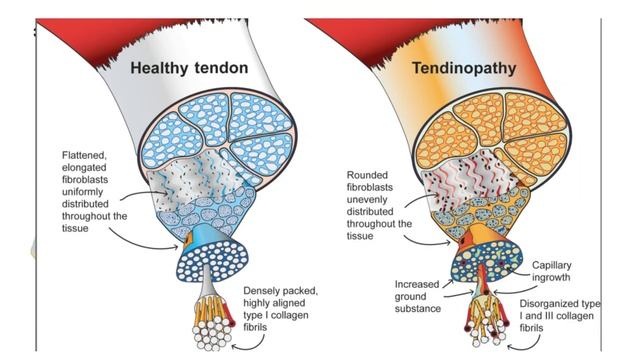 Отрыв бицепса. Особенности травмы и принципы профилактики смотреть онлайн