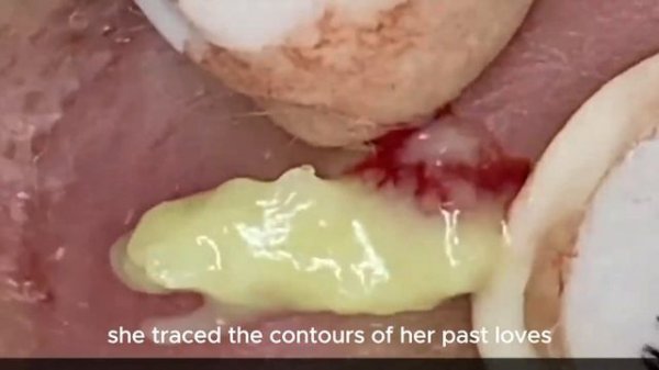 😍 Skin Care Pimple Extraction. Facial Blackhead Removal with "Echoes of Departure History"