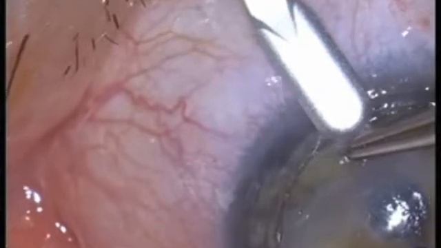 "Tuck In" Lamellar Keratoplasty for Post Keratoplasty Keratoconus смотреть онлайн