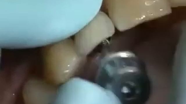 http://dentadent.ru/ Имплантанты системы Штрауман-Prosthetics 1 kapitel3 смотреть онлайн