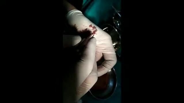 04/02/19 hair transplant at regrowth hair transplant centre 5500 graft смотреть онлайн