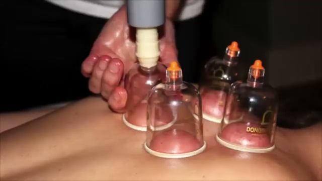 Cupping Therapy