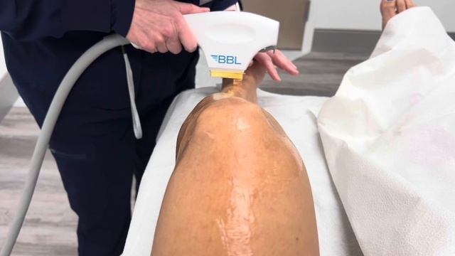 BBL (BroadBand Light) Laser Technology for Scar Treatment смотреть онлайн