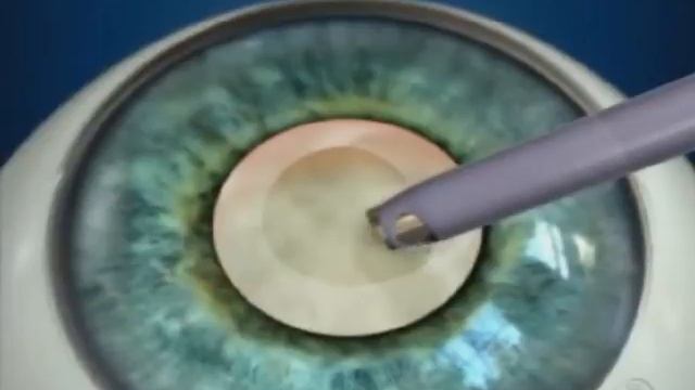 Факоэмульсифакация катаракты