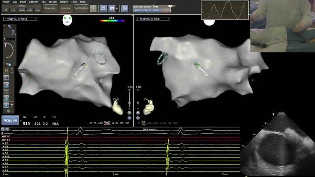Zero Fluoro AF Ablation Carto ICE