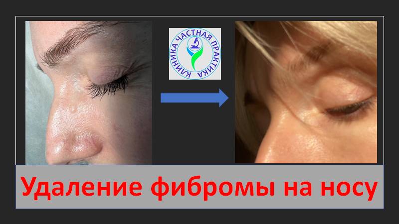 Удаление фибромы на носу смотреть онлайн