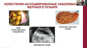 Холецистит. ЖКБ