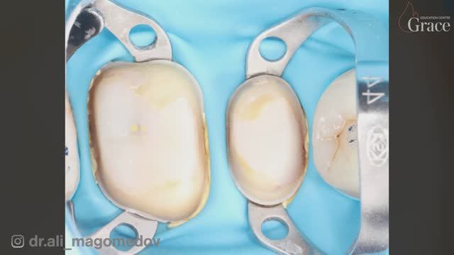 Коффердам. Урок от Али Магомедова