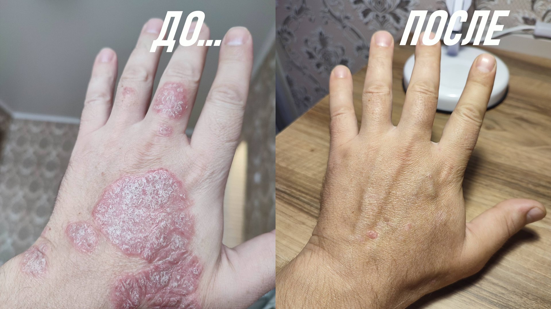 Псориаз уйдет за 3 месяца. Личный опыт! Как правильно лечить псориаз? смотреть онлайн