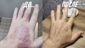 Псориаз уйдет за 3 месяца. Личный опыт! Как правильно лечить псориаз?