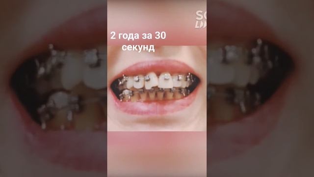 #4 "Два года за 30 сек" Путь к ЧЛХ в 40 лет #брекеты #члх #дистальныйприкус смотреть онлайн