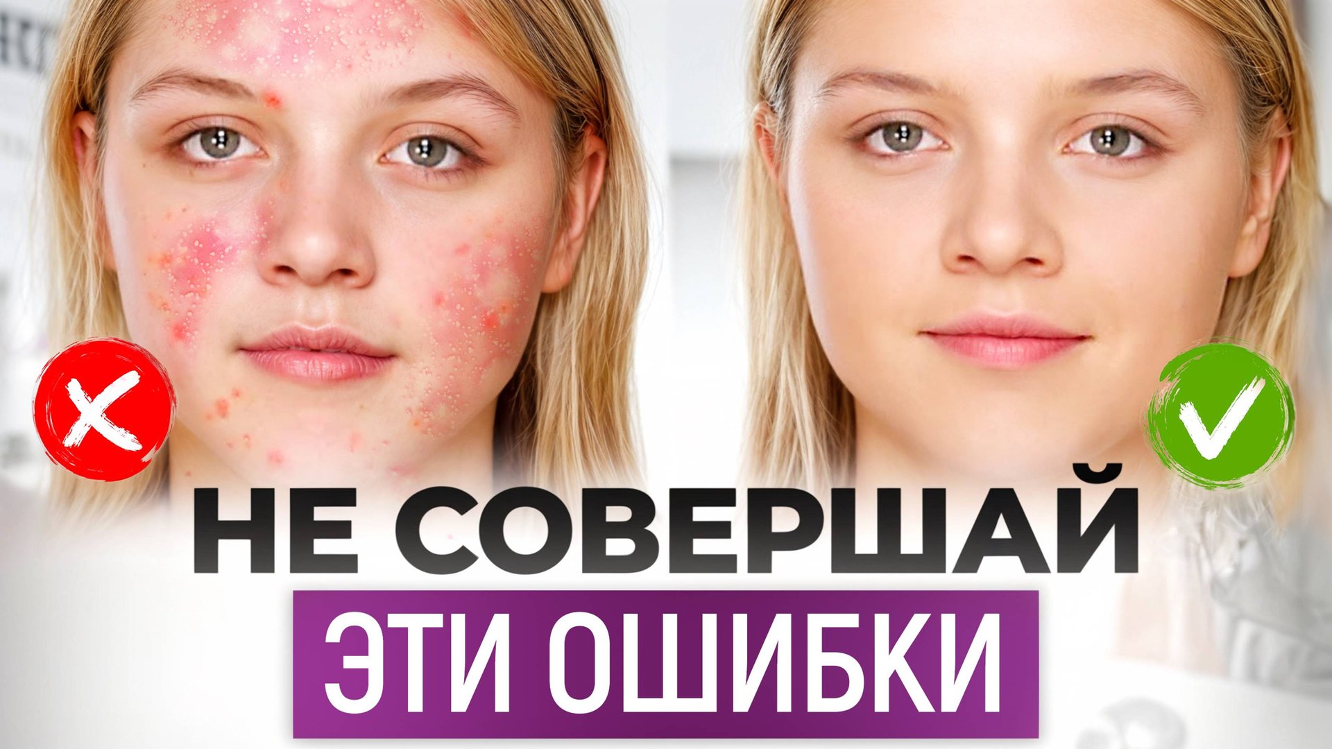 НЕОЧЕВИДНЫЕ привычки, которые ВЫЗЫВАЮТ ПРЫЩИ на лице! / Почему появляется акне и как лечить?