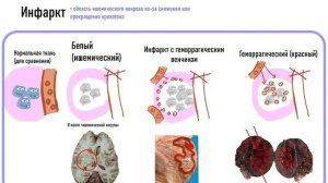 На протяжении 7 минут доказываю что не любой инсульт = инфаркт мозга