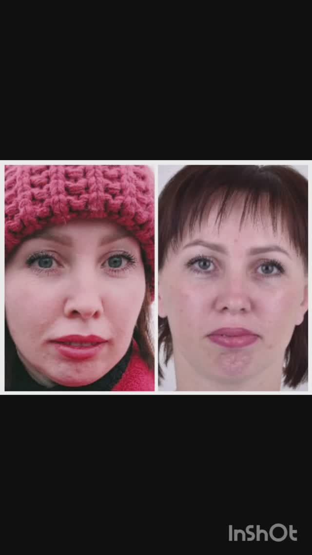 #6 Брекеты заметно улучшают пропорции лица. Путь к ЧЛХ в 40 лет #брекеты #члх #дистальныйприкус смотреть онлайн