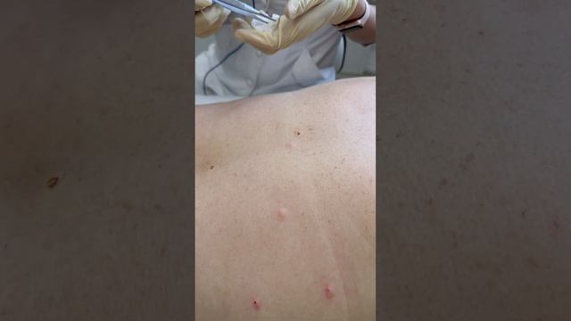 Удаление новообразований смотреть онлайн