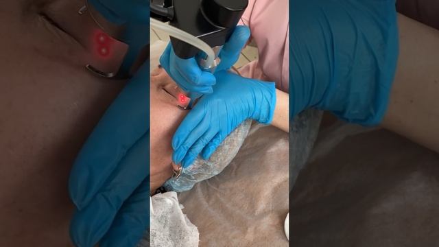 Лазерная шлифовка кожи смотреть онлайн