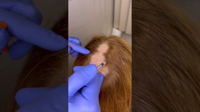 Плазмотерапия для волос смотреть онлайн