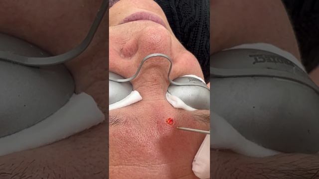 Удаление родинок (невусов) смотреть онлайн