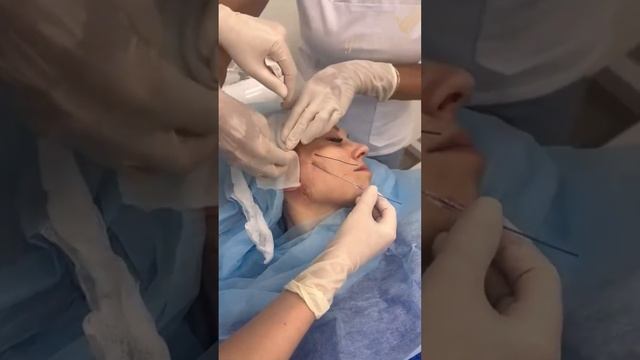 Нитевой лифтинг смотреть онлайн