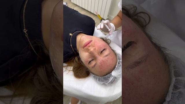 Плазмолифтинг лица смотреть онлайн