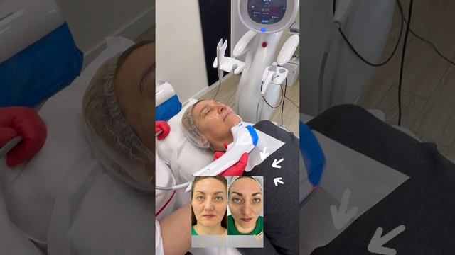 СМАС лифтинг смотреть онлайн