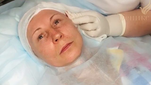 Процедура армирования лица нитями Аптос смотреть онлайн