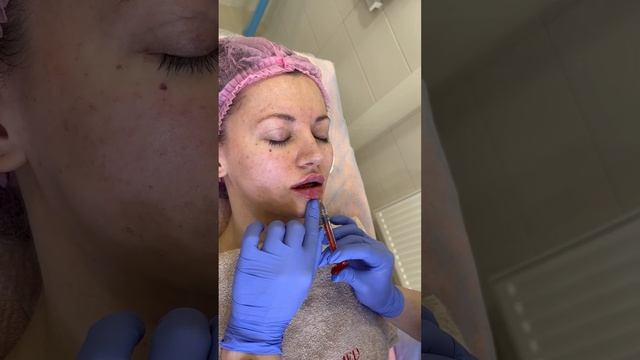 Коррекция формы и увеличение объема губ смотреть онлайн