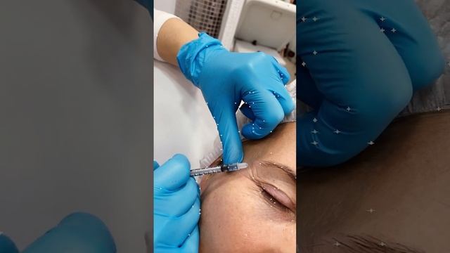 Заполнение морщин смотреть онлайн