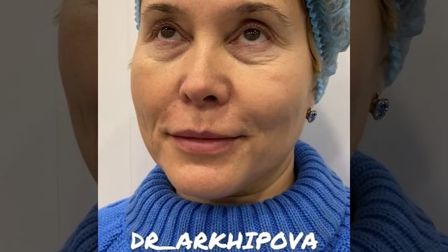 Коррекция скул филлерами смотреть онлайн