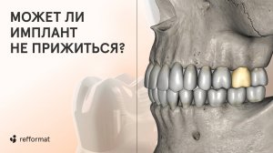 🔎 Тест на отторжение имплантов: может ли имплант не прижиться? И что дает гарантия на импланты?
