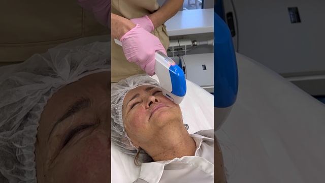 SMAS лифтинг Ultraformer смотреть онлайн