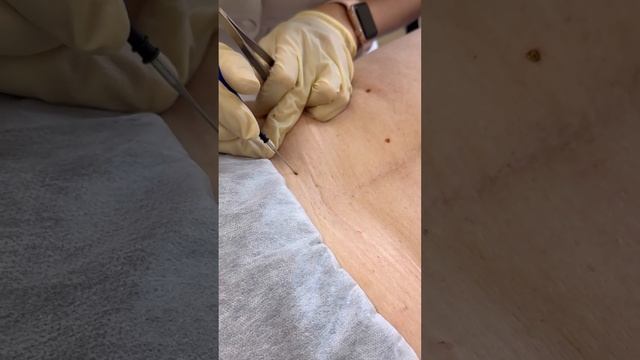 Удаление папиллом смотреть онлайн