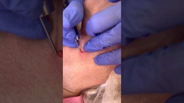 Удаление кератом смотреть онлайн