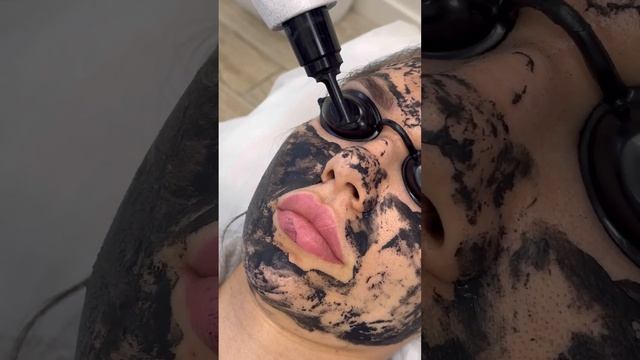 Карбоновый пилинг смотреть онлайн