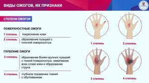 Тема4. Вопрос 1. Виды ожогов, их признаки