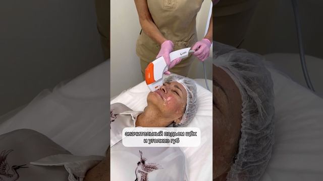 SMAS лифтинг смотреть онлайн