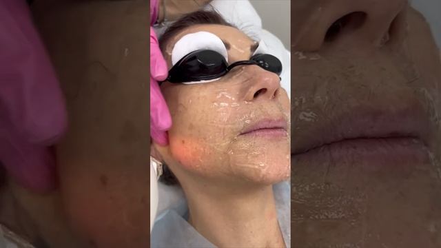 Фотоомоложение на платформе М22 смотреть онлайн