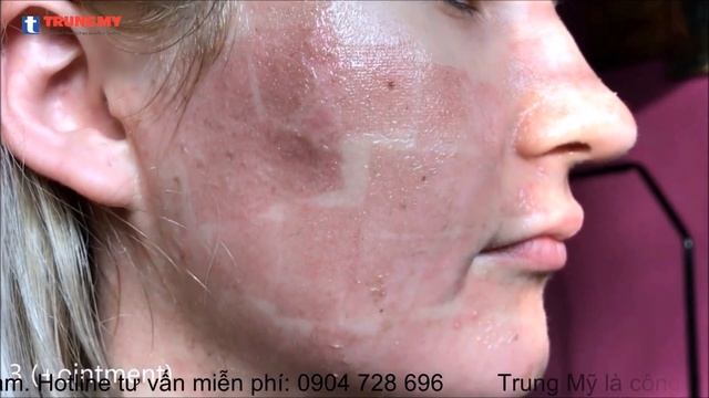 Quá trình cải thiện sẹo sau 1 tuần với Laser Fractional Fraxis смотреть онлайн