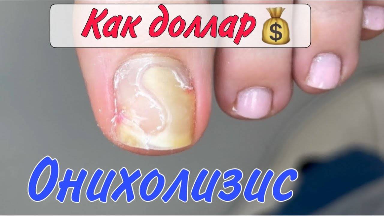 Оторвался ноготь_онихолизис_как зачистить ноготь смотреть онлайн
