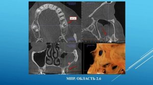 Чибисова М.А. КЛКТ для врачей-стоматологов: как видеть на КТ больше?