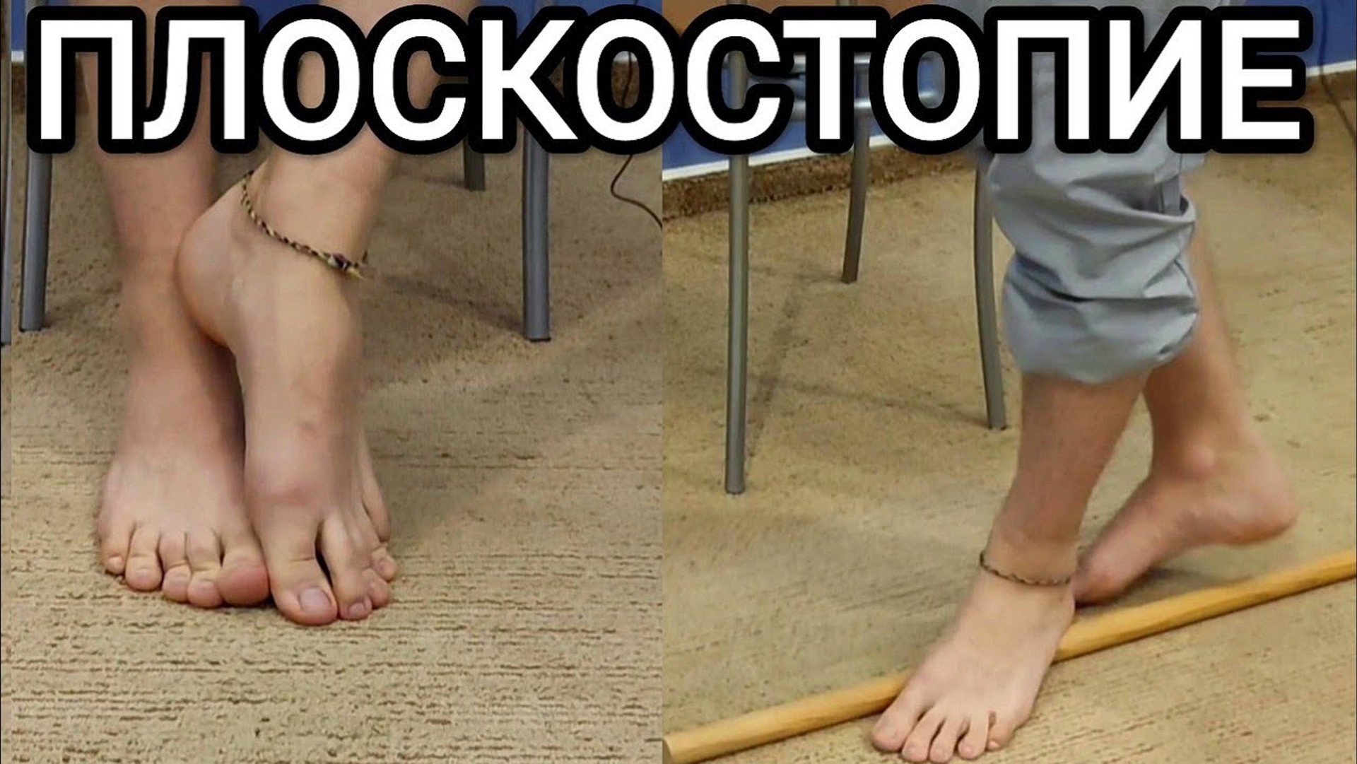 Лечебная физкультура при ПЛОСКОСТОПИИ - Гимнастика на каждый день смотреть онлайн