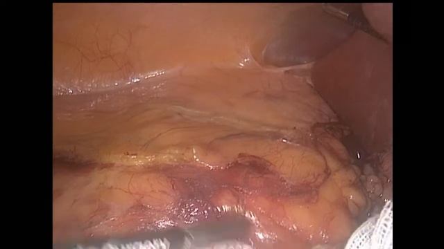 Laparoscopic Right Partial Nephrectomy / Лапароскопическая резекция правой почки смотреть онлайн