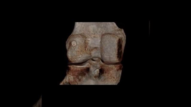 irad-ka knee kneecap fracture CT 3D rekonstruction смотреть онлайн