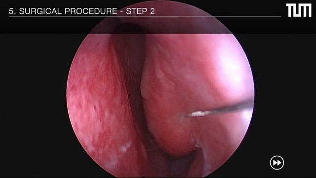 RF reduction / ablation of the nasal turbinates - Radiofrequenz Nasenmuschel Operation Verkleinerun смотреть онлайн