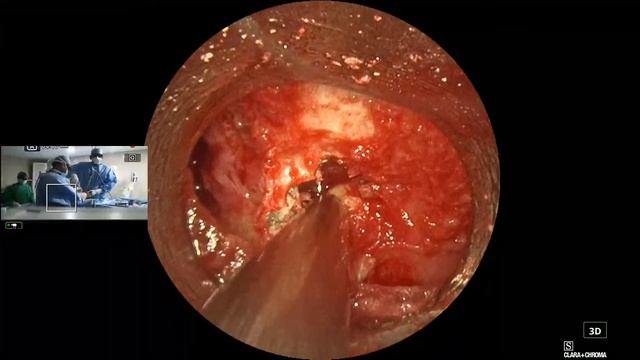 ENDOSPINE 3D SYSTEM 52Y MALE LT L4-L5;L5-S1 DISC смотреть онлайн