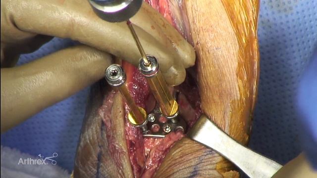 Pilon Fracture with Anterolateral and Posterior Distal Tibia Fracture Plating System смотреть онлайн