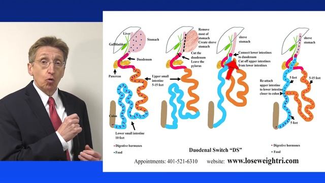 11. RWMC - The Duodenal Switch (DS) смотреть онлайн