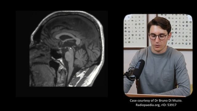 Ventricles and Cisterns of the Brain | Radiology anatomy part 1 prep | MRI brain смотреть онлайн